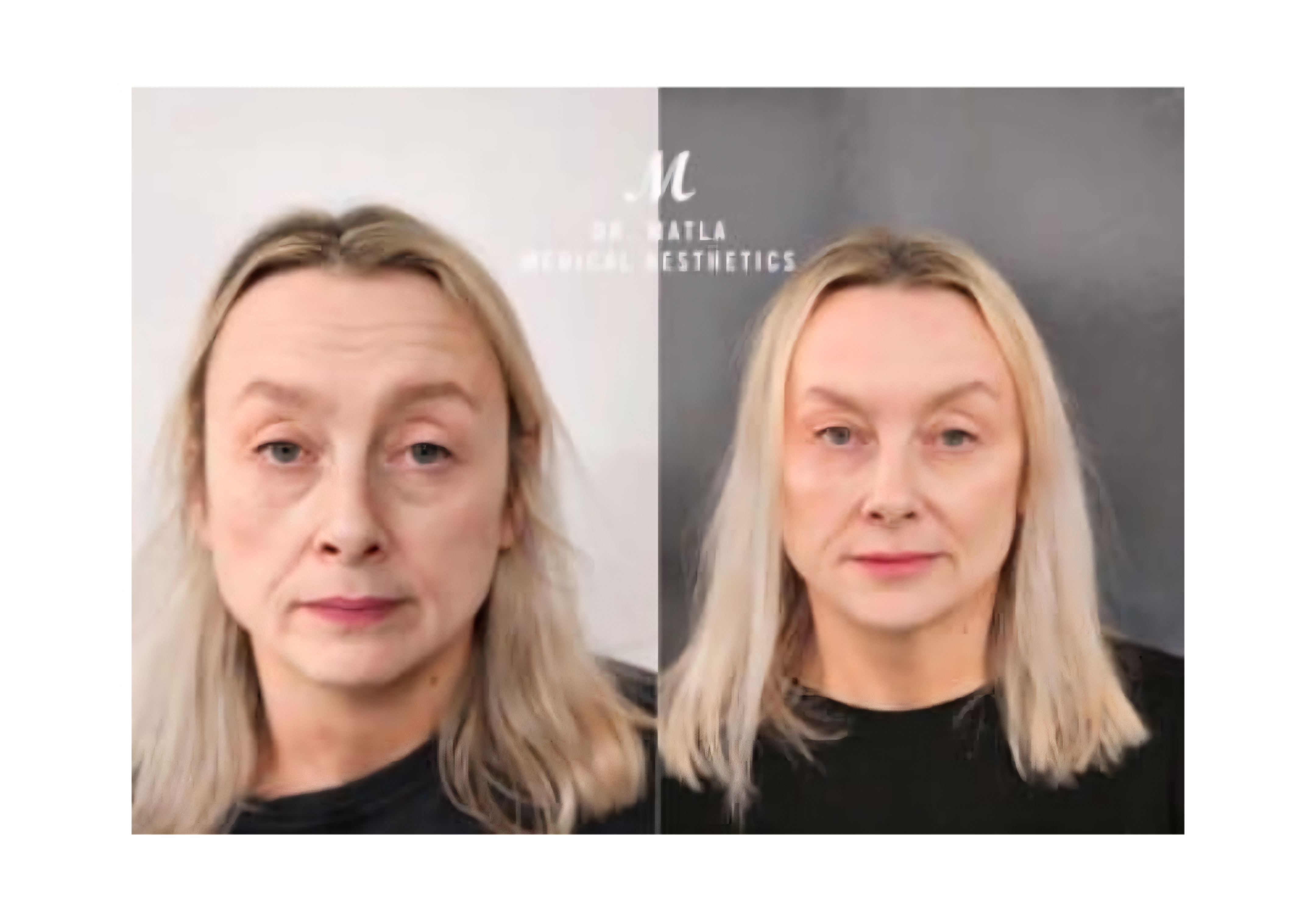 Eye thread lift